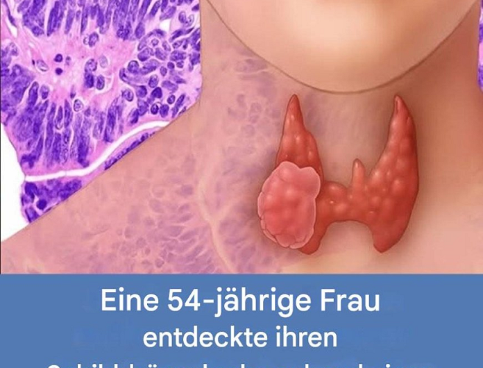 Mein Kloß im Hals war kein Stress – sondern Schilddrüsenkrebs. Hätte ich länger gewartet, wäre ich heute vielleicht nicht mehr hier