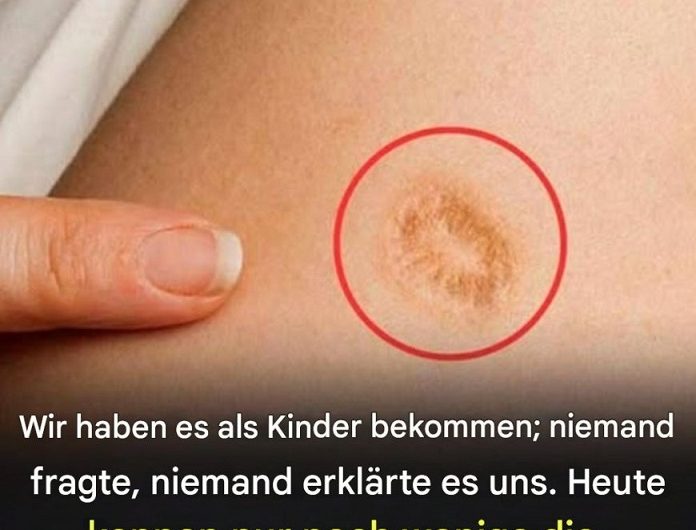5 häufige Irrtümer über die runde Narbe am Oberarm – eine stille Geschichte, die viele von uns tragen