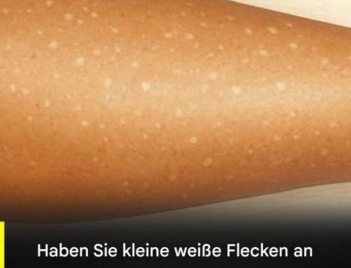 Weiße Flecken auf der Haut – Meine Gedanken über mögliche Ursachen, Vitamine und warum man ruhig bleiben sollte