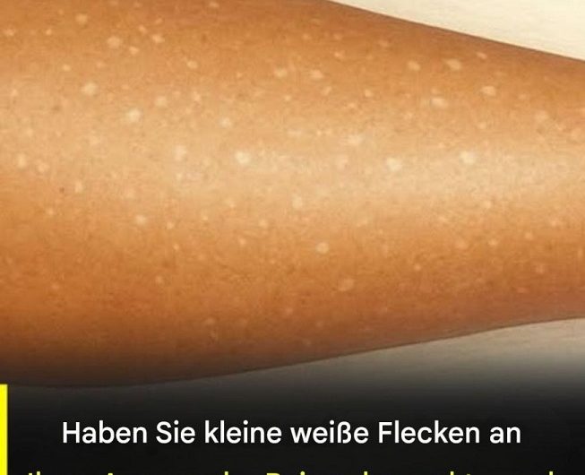Weiße Flecken auf der Haut – Welche Ursachen wirklich dahinterstecken können